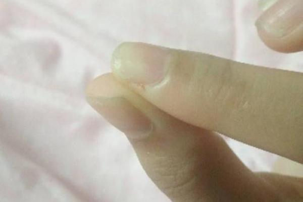 梦见白蛇咬自己的手